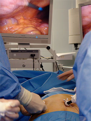 Cirurgia laparoscòpica