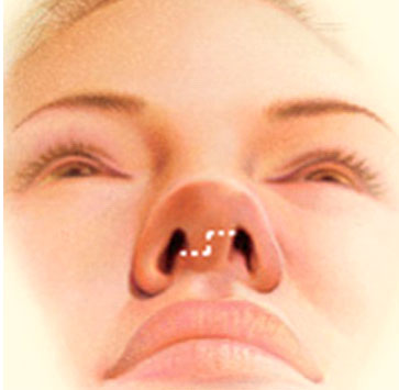 Les incisions es realitzen a l'interior o a la base del nas, permetent remodelar els cartílags i ossos del nas